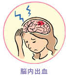 脳内出血