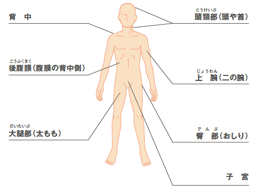 図：悪性軟部腫瘍ができやすい場所