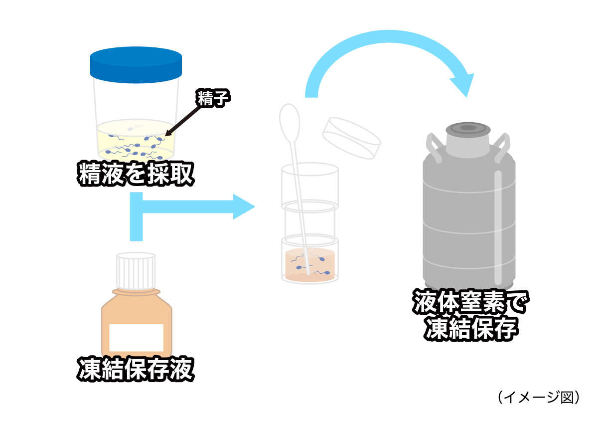 精子凍結［未婚・既婚の場合］（イメージ図）