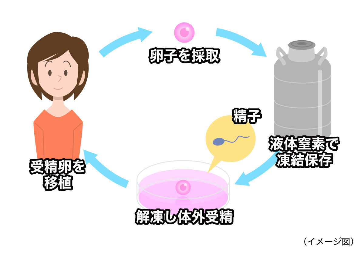未受精卵子凍結［未婚の場合］（イメージ図）