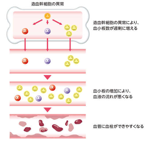 本態性血小板血症の経過