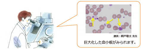 本態性血小板血症の血液標本