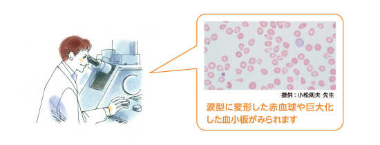 骨髄線維症の血液標本