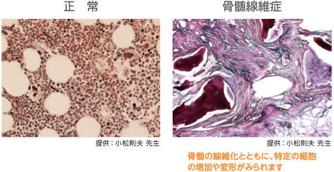 骨髄線維症の検査