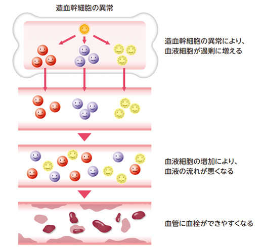 真性多血症の経過