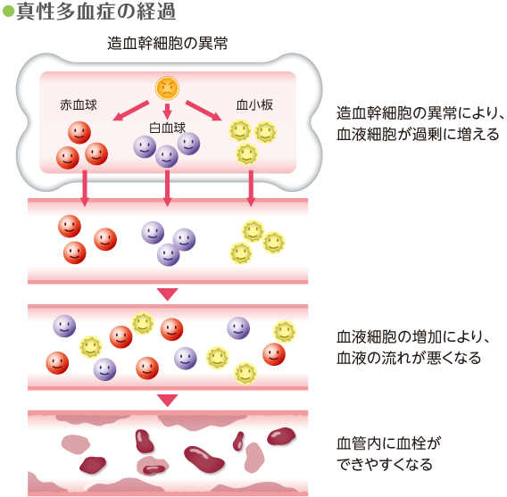 真性多血症の経過
