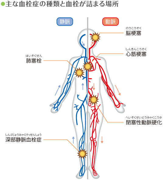 主な血栓症の種類と血栓が詰まる場所