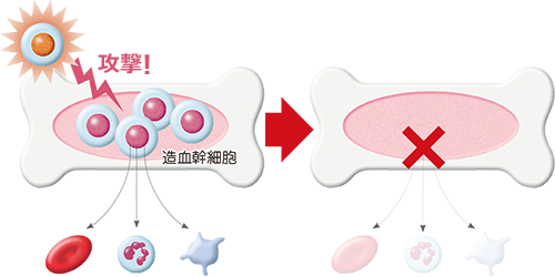 再生不良性貧血のイメージ