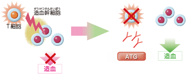 免疫抑制療法:抗胸腺細胞免疫グロブリン:ATG