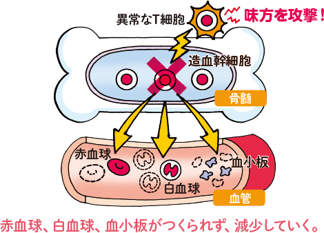 再生不良性貧血(AA)の状態