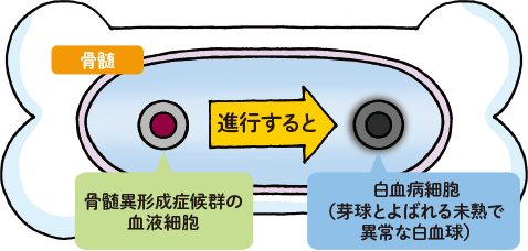 骨髄異形成症候群の血液細胞