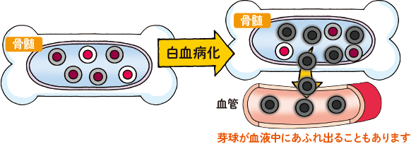 芽球は骨髄の中で無秩序に増殖します