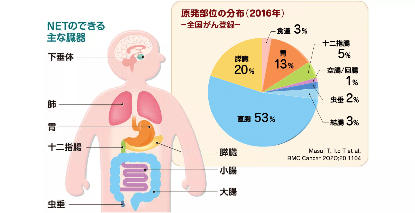 NETのできる主な臓器と割合