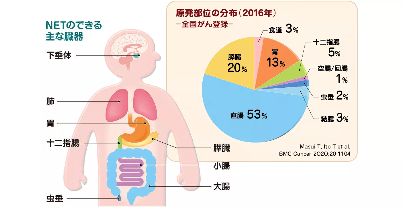 NETのできる主な臓器と割合