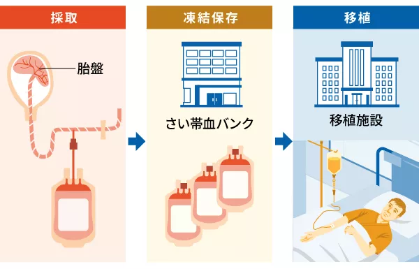 胎盤から採取→さい帯血バンクに凍結保存→移植施設で移植