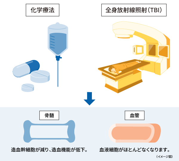 イメージ画像：病気にかかった血液細胞を破壊する（前処置）