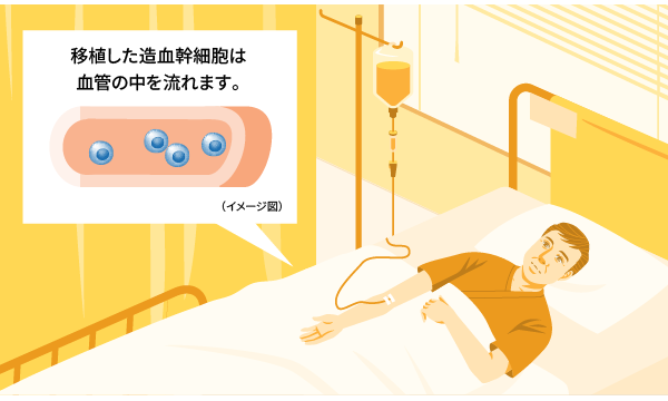 イメージ画像：造血幹細胞の移植
