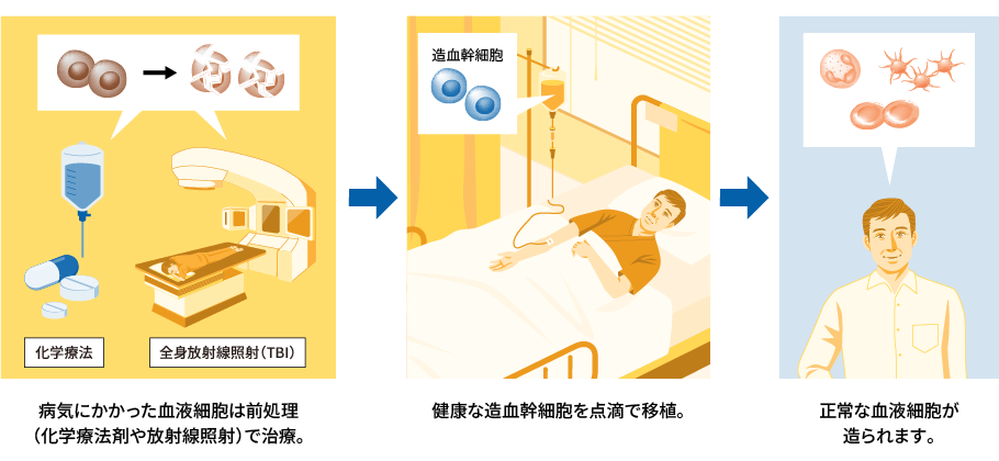 病気にかかった血液細胞は前処理(化学療法剤や放射線照射) で治療。（化学療法　全身放射線照射 (TBI)）→健康な造血幹細胞を点滴で移植。→正常な血液細胞が造られます。