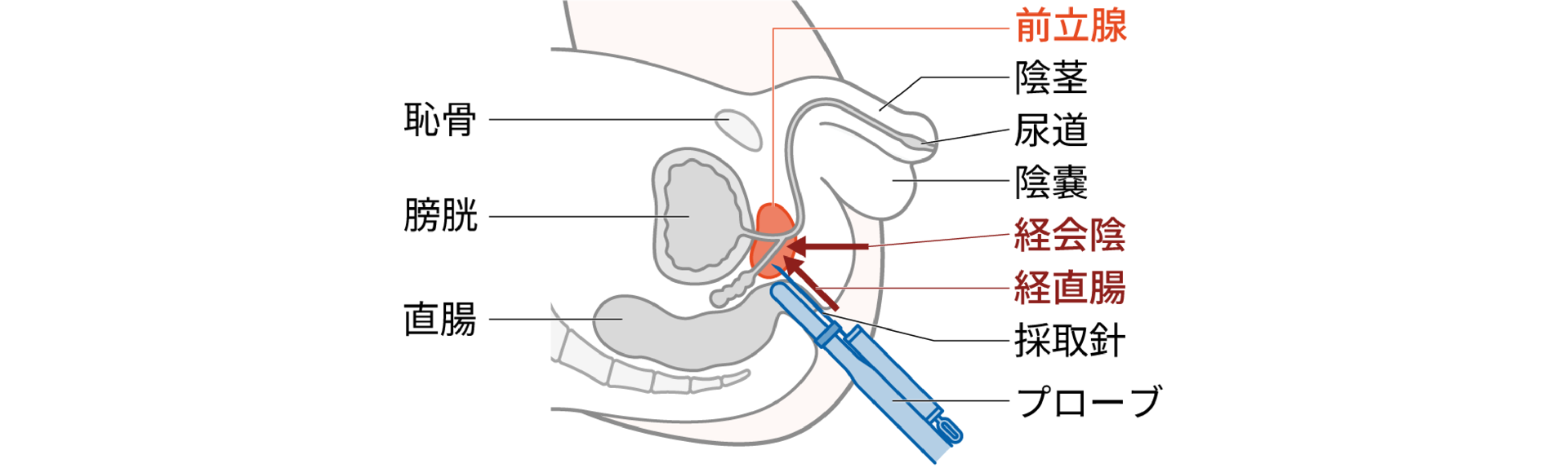 画像：前立腺生検
