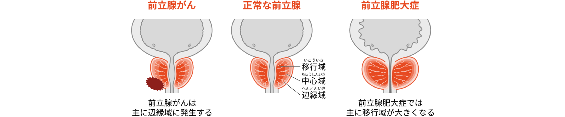 画像:前立腺がんは主に辺縁域に発生する、前立腺肥大症では主に移行域が大きくなる