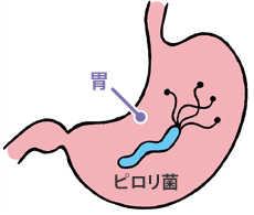 ヘリコバクター・ピロリ菌のimage