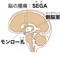 上衣下巨細胞性星細胞腫（SEGA）のイラスト