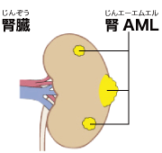腎臓の血管筋脂肪腫（腎AML）のイラスト