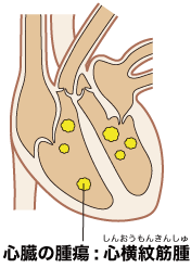 心臓の腫瘍:心横紋筋腫 のイラスト