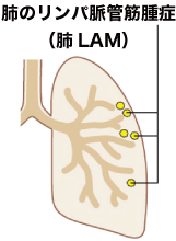 肺のリンパ脈管筋腫症 のイラスト