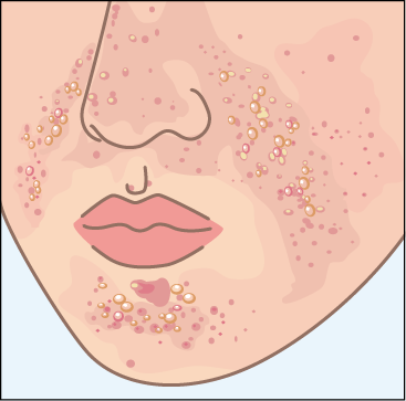 顔の血管線維腫のイラスト