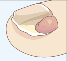 爪の線維腫のイラスト