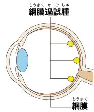 網膜過誤腫のイラスト