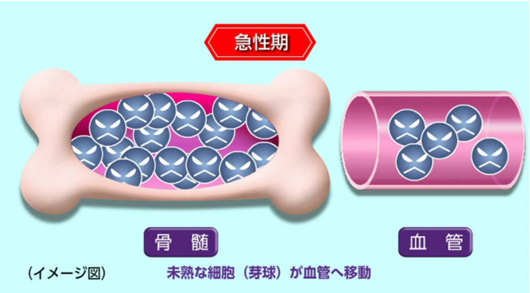 CMLの急性期のイメージ