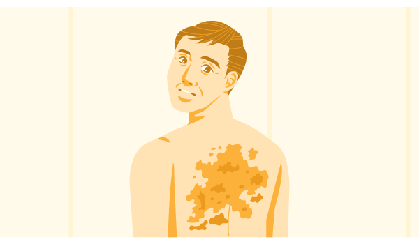 イラスト:背中の皮膚が荒れている男性