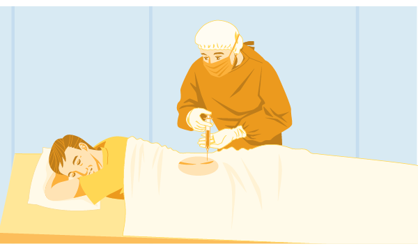 イラスト：骨髄の採取