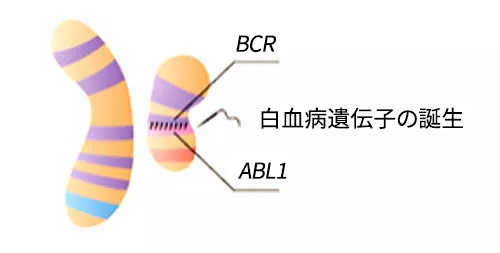 BCR－ABL遺伝子