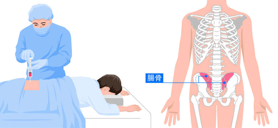 イラスト：骨髄穿刺をしている様子