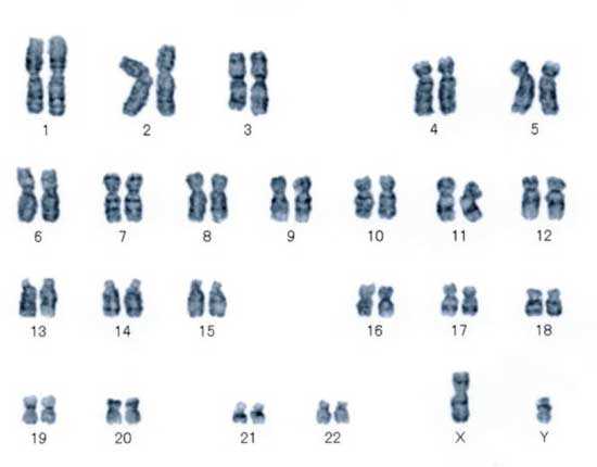 正常な場合の染色体